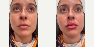 Woman treated with Juvederm - Woman treated with Juvederm XC as lip fillers