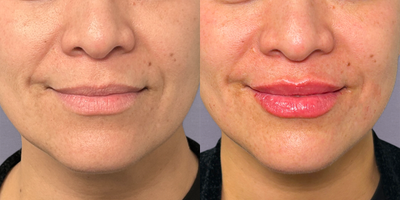 1 syringe of Juvderm Vollure XC for Nasolabial Folds - Juvderm Vollure XC is expertly crafted for smoothing moderate to severe facial wrinkles and folds, such as nasolabial folds, bunny lines, lip lines, and more offering soft and natural correction in an instant. Our patient used 1 syringe of Juvderm Vollure XC to smooth her nasolabial folds, achieving her own natural-looking results.