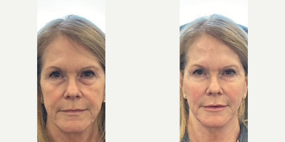 Woman treated with Dermal Fillers - Woman treated with Dermal Fillers