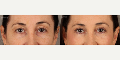 Upper and Lower Blepharoplasty with Fat Grafting and CO2 Laser - 38-year-old female with a history of displeasure with her upper eyelid contour and excess skin, and lower eyelid aging. She had tried and failed undereye fillers many times before deciding to undergo surgery. She is shown 6 months after an upper blepharoplasty (eyelid lift) with fat transposition to reduce upper eyelid skin redundancy and create a more youthful contour. She also underwent a transconjunctival (scarless) lower blepharoplasty to remove lower eyelid bags, fat grafting to the eyelids and mid-cheek to contour areas of hollowness, and fractionated CO2 laser to tighten and smooth skin.