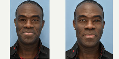 55-64 year old man treated with Injectable Fillers - Injectable Filler - 3 cc