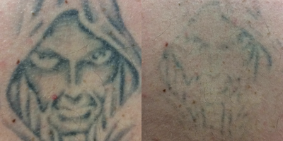 25-34 year old man treated with Tattoo Removal on back - The pictures show initial treatment and then after two treatments using the Enlighten. I do numb all my patients for comfort prior to treatment. His first treatment was in June 2015, second in October 2015 and third in February 2016.