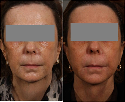 53 Year Old female with loss of cheek volume, hollowness under her eyes, nasolabial folds, and sagging jowls and neck.  J - 
	Before: 57 year old female who is bothered by laxity in her neck and jaw line. Would like to treat her jowls and turkey neck without a surgical neck lift if possible. She also is noticing that her cheeks are losing volume, support, and are beginning to sag. This is also causing her marionette lines to deepen. After: 60 years old, 15 months after Smart Lipo procedure where excess fat from her neck and jaw line were lasered and skin tightened with only 2 days downtime. She had a Liquid Lift, where Juvederm Voluma was used to restore lost cheek volume. Juvederm Voluma can last up to 2 years after a single treatment. Results of Smart Lipo are dramatic and long lasting. For patients who want skin tightening but dont have excess fat, Precision Tx can be performed. This is a newer type of Smart Lipo laser. We will often combine both procedures- Smart Lipo under the chin and Precision Tx for the jaw line.