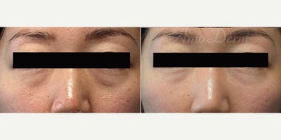35-44 year old woman treated with Voluma, Juvederm, Volbella - 4D Under Eye Lift - Treatment of dark circles & bags under eyes and cheek restoration with Belotero, Restylane, Volbella and Voluma
