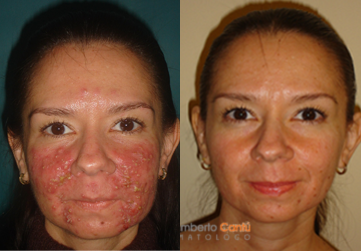 Accutane tratment - 
	Patient with traetment for acne
