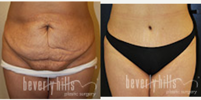 Tummy Tuck - This patient had a tummy tuck, pubic lift, liposuction of the hips and flanks.