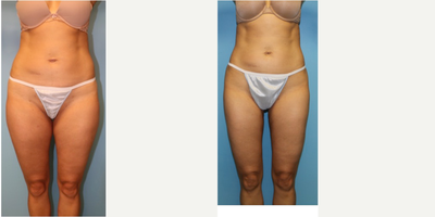 35-44 year old woman treated with Liposuction - Liposuction of lower back, hips, inner and outer thighs.