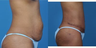35-44 year old woman treated with Tummy Tuck - Patient was unhappy with her appearance after multiple pregnancies, including twins, and was treated with an abdominoplasty