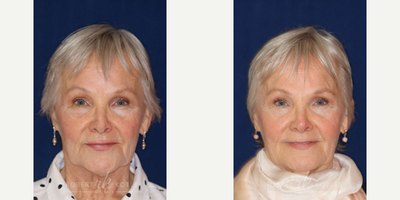 Permanent Non-surgical Revision Rhinoplasty - Restoration to the natural tip and concealment of hump leading to a nose that no longer appears over operated.