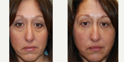 45-54 year old woman treated with Silikon 1000 to her under eye grooves. Two treatments. - These photos demonstrate permanent, non-surgical improvement in the appearance of lower eyelid bags in our lovely and gracious patient. Her result was achieved after two treatments with Silikon-1000, an off-label filler for permanent results. Thank you.