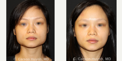 25-34 year old woman treated with Jaw Reduction - Patient requested jaw reduction to soften jawline for a more feminine look.
