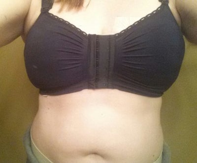 6 month Breast Reduction Update 38H-38D 