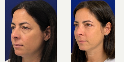 45-54 year old woman treated with Eyelid Surgery - My 48 year old patient 4 months post Facial Fat Transfer, Upper and Lower Blepharoplasty. The excess skin from her upper eyelid has been removed and the under eye bags are no longer and the volume loss has been restored in her mid face from the fat transfer.