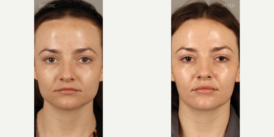 Botox for Jawline Slimming - 27-year-old female who presented complaining that her face had become more square, corresponding to pain and tooth damage from grinding and clenching her teeth. She is shown 2 months after neurotoxin (Botox) treatment to these muscles, resulting in jawline slimming and a more heart-shaped face. She also has complete relief from her symptoms related to teeth grinding and clenching. At the time of treatment she also received lip filler, as noted from the improvement in shape and volume of her lips.