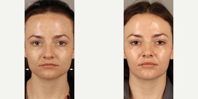 Botox for Jawline Slimming - 27-year-old female who presented complaining that her face had become more square, corresponding to pain and tooth damage from grinding and clenching her teeth. She is shown 2 months after neurotoxin (Botox) treatment to these muscles, resulting in jawline slimming and a more heart-shaped face. She also has complete relief from her symptoms related to teeth grinding and clenching. At the time of treatment she also received lip filler, as noted from the improvement in shape and volume of her lips.
