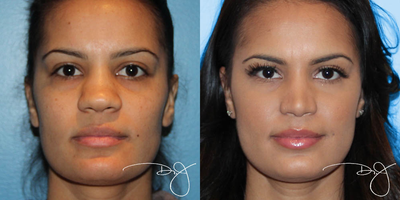 25-34 year old woman treated with Rhinoplasty - Open rhinoplasty with weir excision to bring in the nostrils, refine, reshape and define the nasal tip