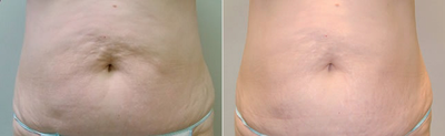 Woman treated with Velashape - Woman treated with Velashape