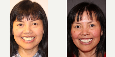 45-54 year old woman treated with Dental Implants - Upper removable implant retained denture to restore health, functionality and aesthetics.