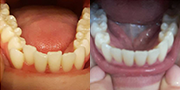 Straighten your teeth without braces - Photo provided courtesy of SmileDirectClub.
