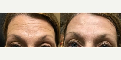 55-64 year old woman treated with Microneedling - Patient shown before and 2 weeks after Neuromodulator injections Microneedling treatment and Belotero Injections to soften forehead lines.