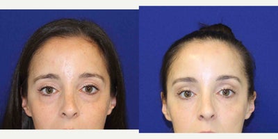 35-44 year old woman treated with Belotero - 36 year old female who was unhappy with her tired eyes. She does not have the time right now to undergo lower eyelid surgery, so we decided on a less invasive option. She underwent two syringes of belotero to the under eye area and voluma to her cheeks and botox to her crows feet, here she is after 2 weeks looking refreshed and rejuvenated.