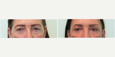65-74 year old woman treated with Brow Lift - This female senior patient presented with the exclusive desire to elevate her drooping eyebrows.  She did not like how her makeup application was difficult nor preferred the extra weight of the skin resting on her eyelids.  During consultation we agreed to perform a lateral (from the side) browlift.  We discussed the additional potential benefit of additionally performing an upper blepharoplasty to directly remove the excessive thin skin above her lids, but she declined.Her procedure was performed under local anesthesia with a small dose of oral valium taken beforehand.  Procedure time was under one hour.Stitches were placed in the hairline on both sides and were removed 6 days afterwards.  She resumed normal activity and work 10 days after procedure.Her result demonstrates marked elevation and improvement in brow position, specifically of the outer corners of each eye while maintaining a natural appearance.