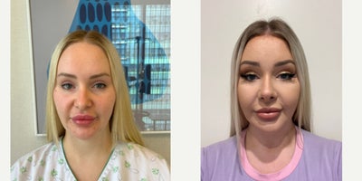 25-34 year old woman treated with Forehead Reduction, Rhinoplasty - .