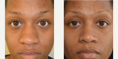 25-34 year old woman treated with African American Rhinoplasty - 25 year old female wanting smaller, thinner nose and bothered by large tip. Nostrils also narrowed.