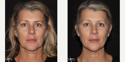 45-54 year old woman treated with Microneedling RF, Morpheus8 - 45-54 year old female treated with non-invasive Morpheus8 Radiofrequency Microneedling to the face and neck for fine lines, wrinkles, neck laxity and jowling. This result is after just one treatment.