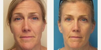 49 year old woman treated with Dysport - This patient was concerned with her crow's feet, forehead, and glabella.