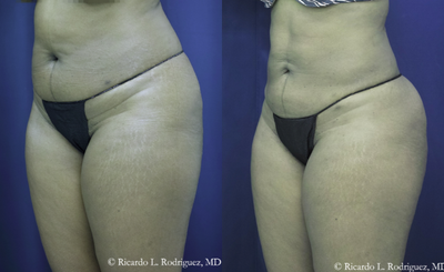 35-44 year old woman treated with Bmore  Butt Lift - 35-44 year old woman treated with Bmore Butt Lift