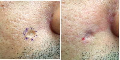 25-34 year old man treated with Subcision Scars Treatment - The patient underwent a scar subcision. This simple and safe office surgery procedure for treatment of depressed scars. It can easily be combined with other treatments such as laser, dermaroller, dermal fillers, scar revisions for maximum efficacy. The after photo is immediately after the procedure. Over the next 4-6 weeks, scar remodeling occurs. In general, 1-3 sessions may be advised, depending on individual's skin type and response to the procedure. In patients with darker skin type, hyperpigmentation/bruising is more noticeable, but tends to fade with time.