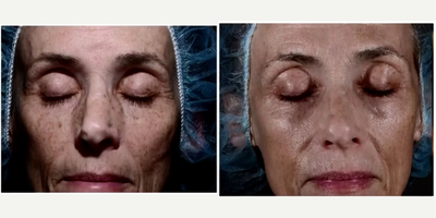 55-64 year old woman treated with Skin Lightening - Amazing results with ONLY 1 treatment of Three for Me
