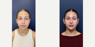 18-24 year old woman treated with Voluma, Restylane, Restylane Lyft, Restylane Defyne, Juvederm - A woman in her 20s, after facial balancing sessions; lips and chin x 3 sessions with various hyaluronic acid fillers.