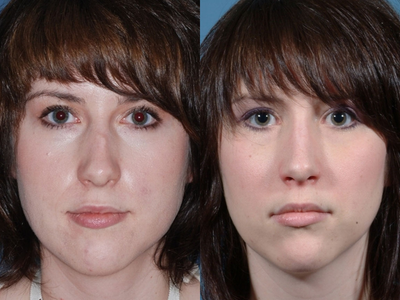Revision Rhinoplasty - 
	This female revision rhinoplasty patient's prior surgery left her with visible hump on the bridge of her nose. Her problems were corrected through closed rhinoplasty techniques.
