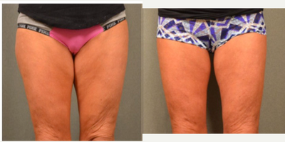 45-54 year old woman treated with Thigh Skin Tightening with Bodytite - 45-54 year old woman treated with Thigh&nbsp;Skin Tightening with Bodytite