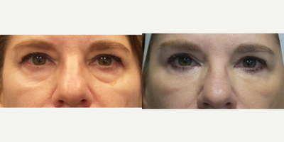 63 year old woman treated with Restylane and Juvederm Voluma - Patient has Restylane to the tear troughs and Juvederm Voluma to her cheeks.