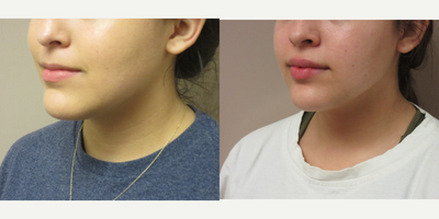 Injectable Fillers in lips - Patient is 19 years old and wanted to have fuller looking lips. One syringe of Juvederm was injected in both her upper and lower lips giving her a beautiful result.