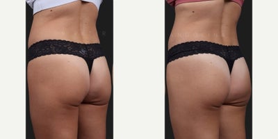 Woman treated with Sculptra Butt Lift, Nonsurgical Butt Lift - A sculptra or non-surgical BBL is a great option and alternative for patients who want to enhance their buttocks without the downtime and commitment associated with surgery. 
