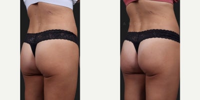 Woman treated with Sculptra Butt Lift, Nonsurgical Butt Lift - A sculptra or non-surgical BBL is a great option and alternative for patients who want to enhance their buttocks without the downtime and commitment associated with surgery. 