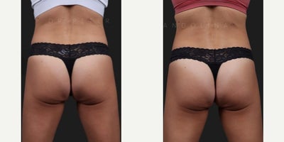 Woman treated with Sculptra Butt Lift, Nonsurgical Butt Lift - A sculptra or non-surgical BBL is a great option and alternative for patients who want to enhance their buttocks without the downtime and commitment associated with surgery. 