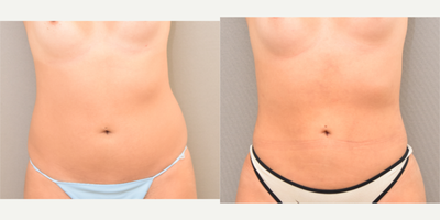 18-24 year old woman treated with Tumescent Liposuction - Liposuction abdomen, flanks and sacrum with fat transfer to buttocks.