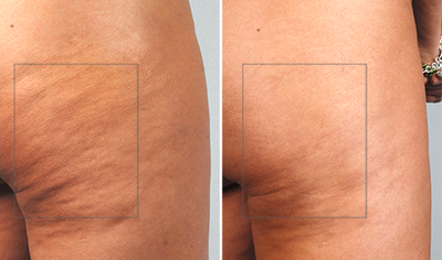 Cellulaze - 
	Cellulaze
