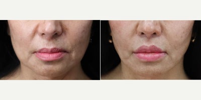 Woman treated with Lip Lift - Woman treated with Lip Lift