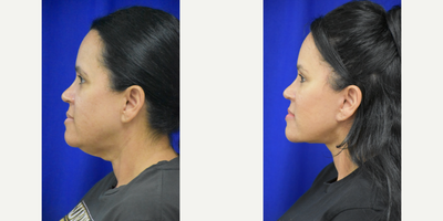 45-54 year old woman treated with Facelift, Lower Facelift - 45-54 year old woman treated with Facelift, Neck Lift, Facial Fat Transfer, Eyelid Surgery