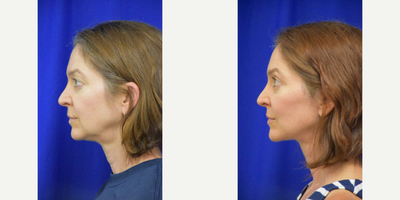 3489 45-54 year old woman treated with Facelift, Neck Lift, Facial Fat Transfer, Eyelid Surgery - 45-54 year old woman treated with Facelift, Neck Lift, Facial Fat Transfer, Eyelid Surgery