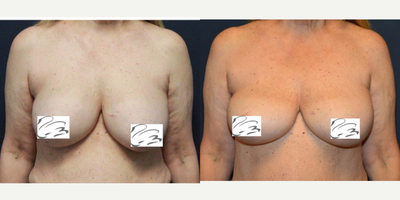 55-64 year old woman treated with Breast Implant Revision - En bloc explantation of ruptured silicone implants with capsulectomy from subglandular plane. Placement of subpectoral silicone implants.