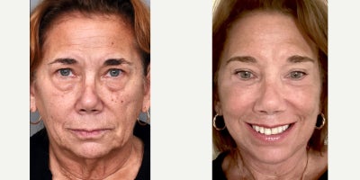 65-74 year old woman treated with Deep Plane Facelift, Neck Lift, Brow Lift, Eyelid Surgery, TCA Peel, Dermabrasion, Facial Fat  - Deep plane facelift with extended neck dissection, deep neck contouring through submental incision, upper-lower eyelid blepharoplasty, partial removal of submandibular salivary glands, upper lip lift, TCA peeling 35%, mechanical dermabrasion for the perioral rhytids