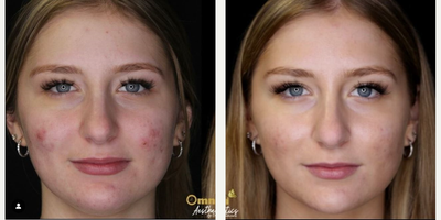 Woman treated with Microneedling RF - Woman treated with Microneedling RF.