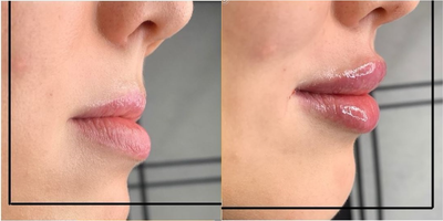 Woman treated with Lip Fillers - Woman treated with Lip Fillers.